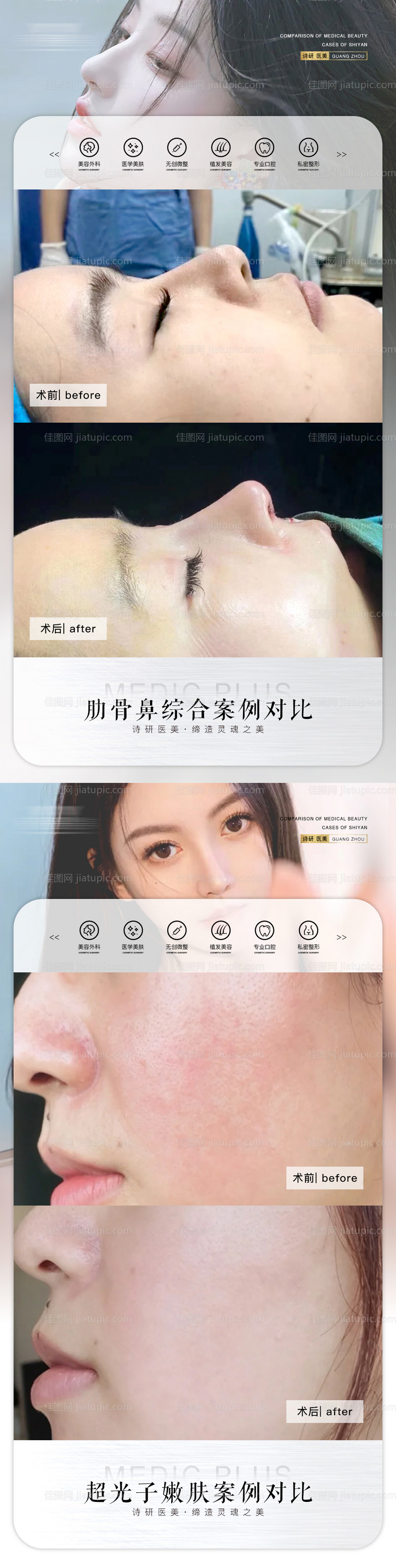 医美案例对比图-源文件